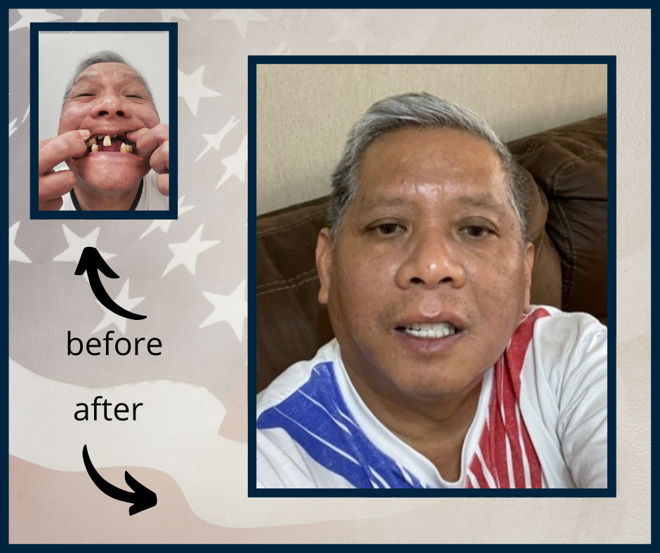 Veteran Carlos Navera Before and After Dental Work